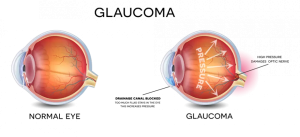 Does Glaucoma Treatment OKC Work?
